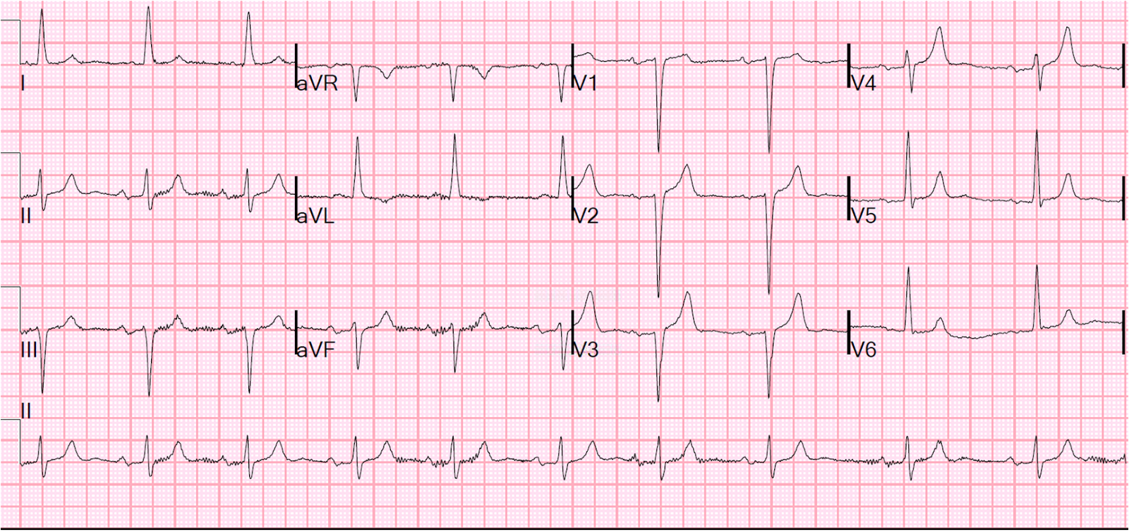 ekg